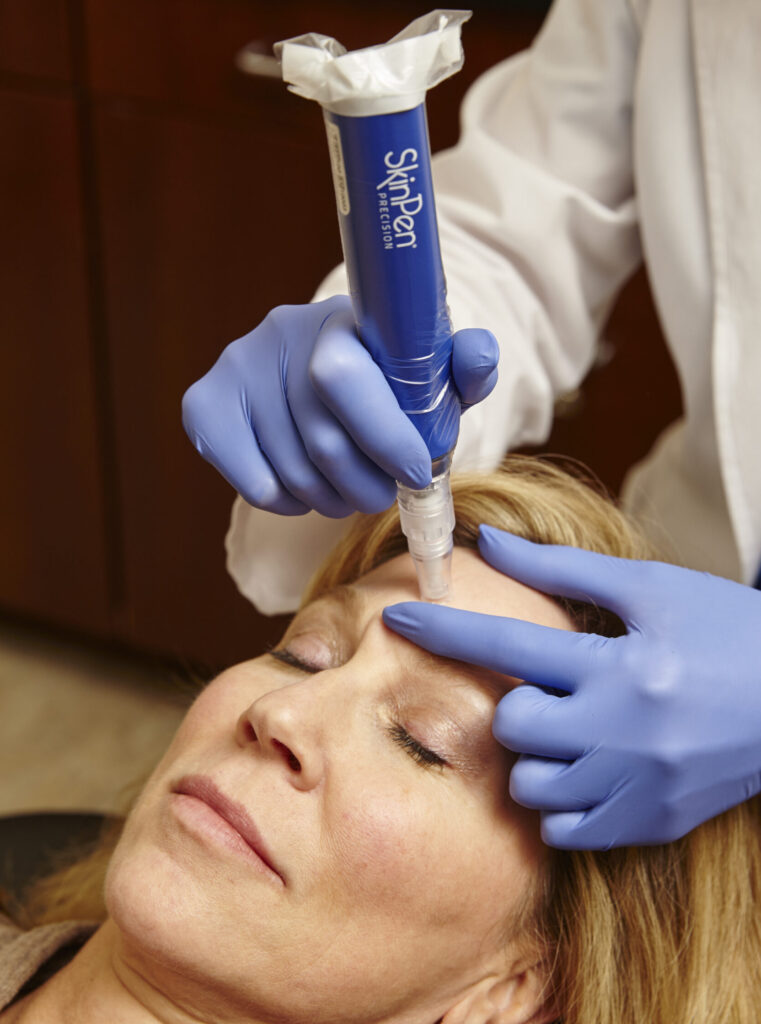 Microneedling Services for Radiant Complexion