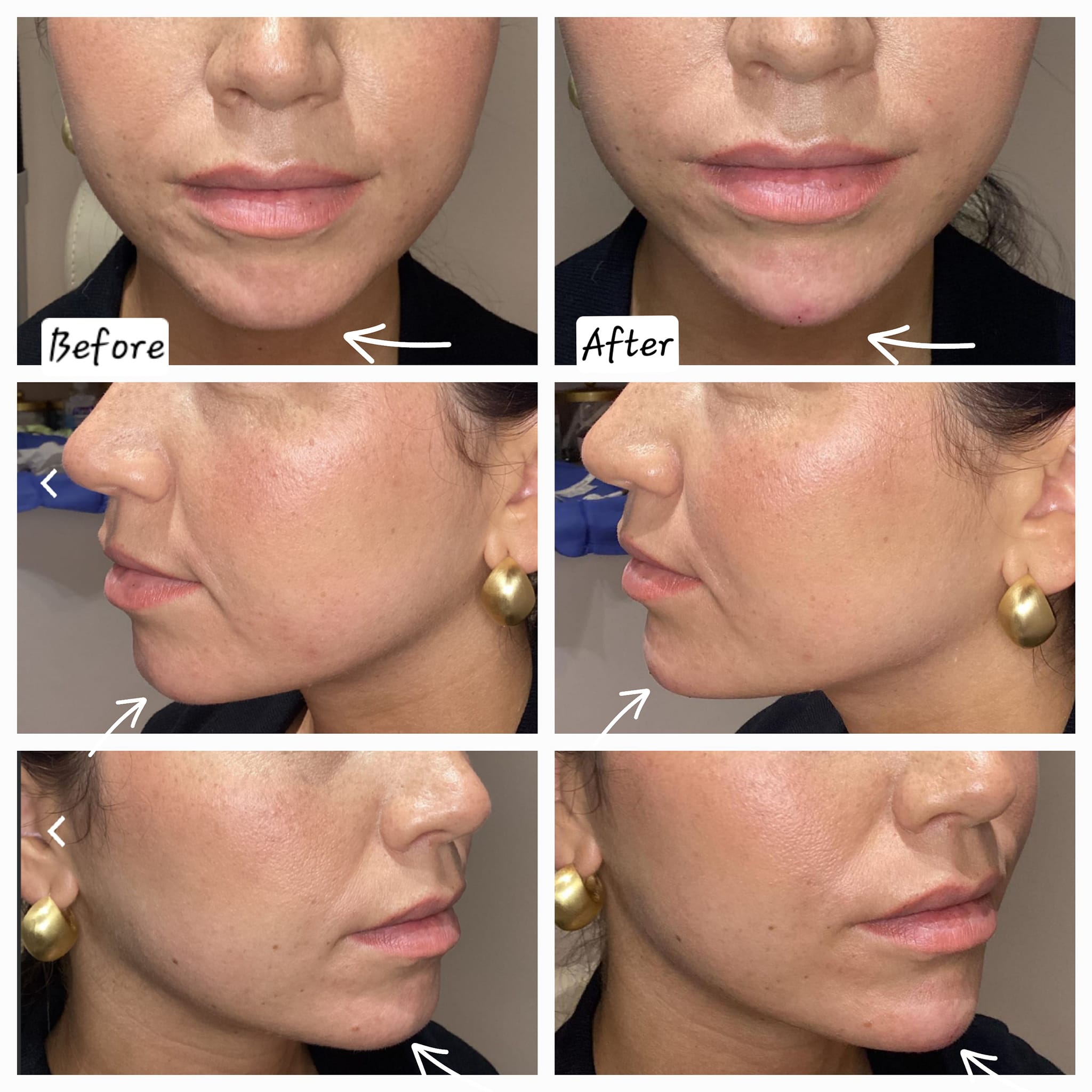 V-shaped jawline created with HA fillers in the chin.