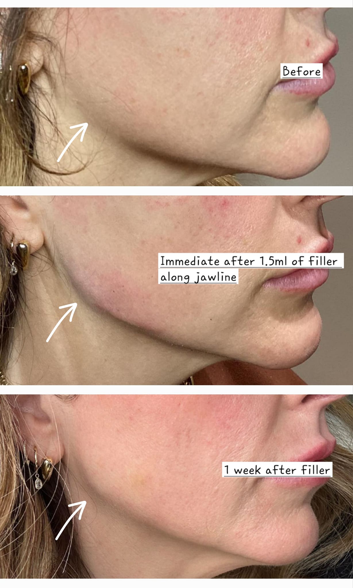 Jawline contour with HA fillers