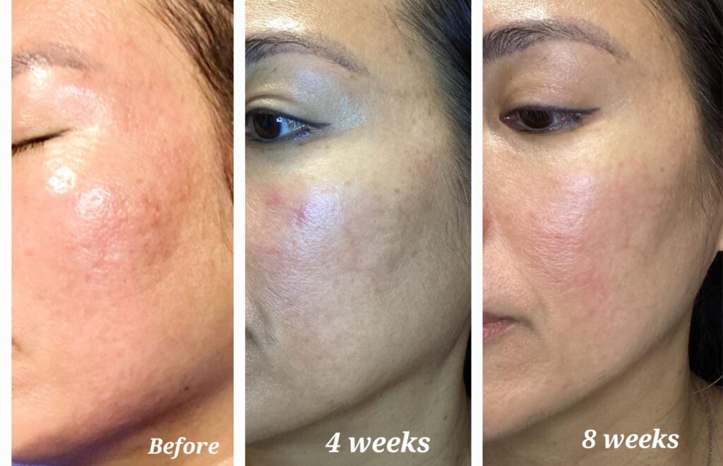 Expert Microneedling for Flawless Skin