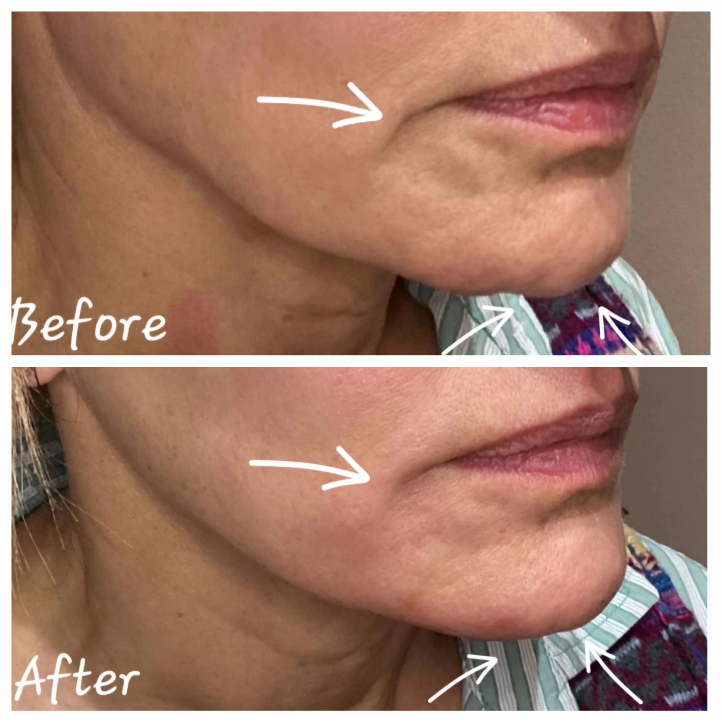 Subcision and HA fillers to restore volume.