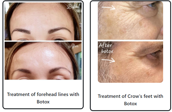 Two Botox treatment before-and-after images. Left: Woman's forehead lines reduced after Botox, showing smoother skin and lifted brow. Right: Man's crow's feet around the eyes softened after Botox, illustrating reduced wrinkles and more youthful appearance. Both images show subtle improvements and are labeled 'Before' and 'After Botox.