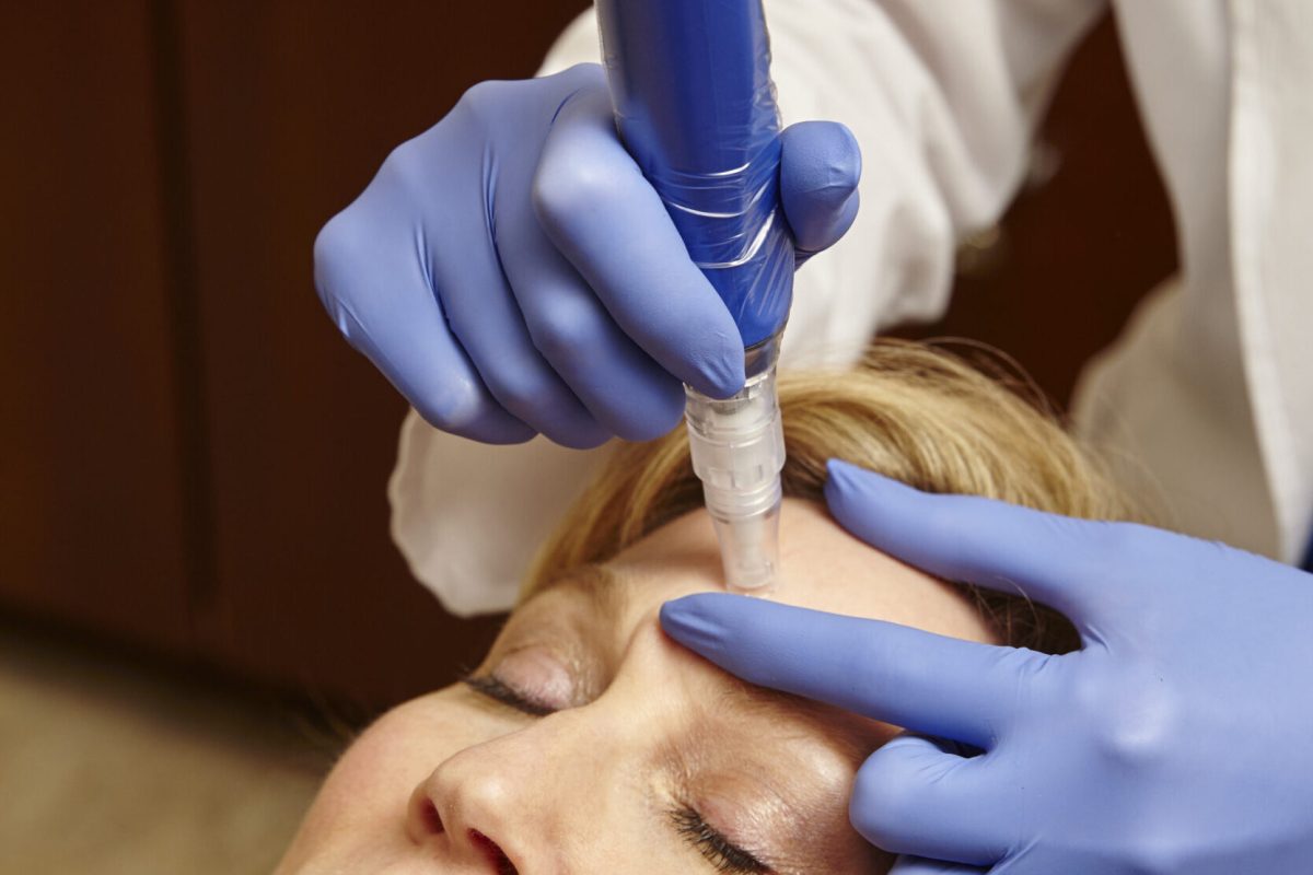 Microneedling Services for Radiant Complexion