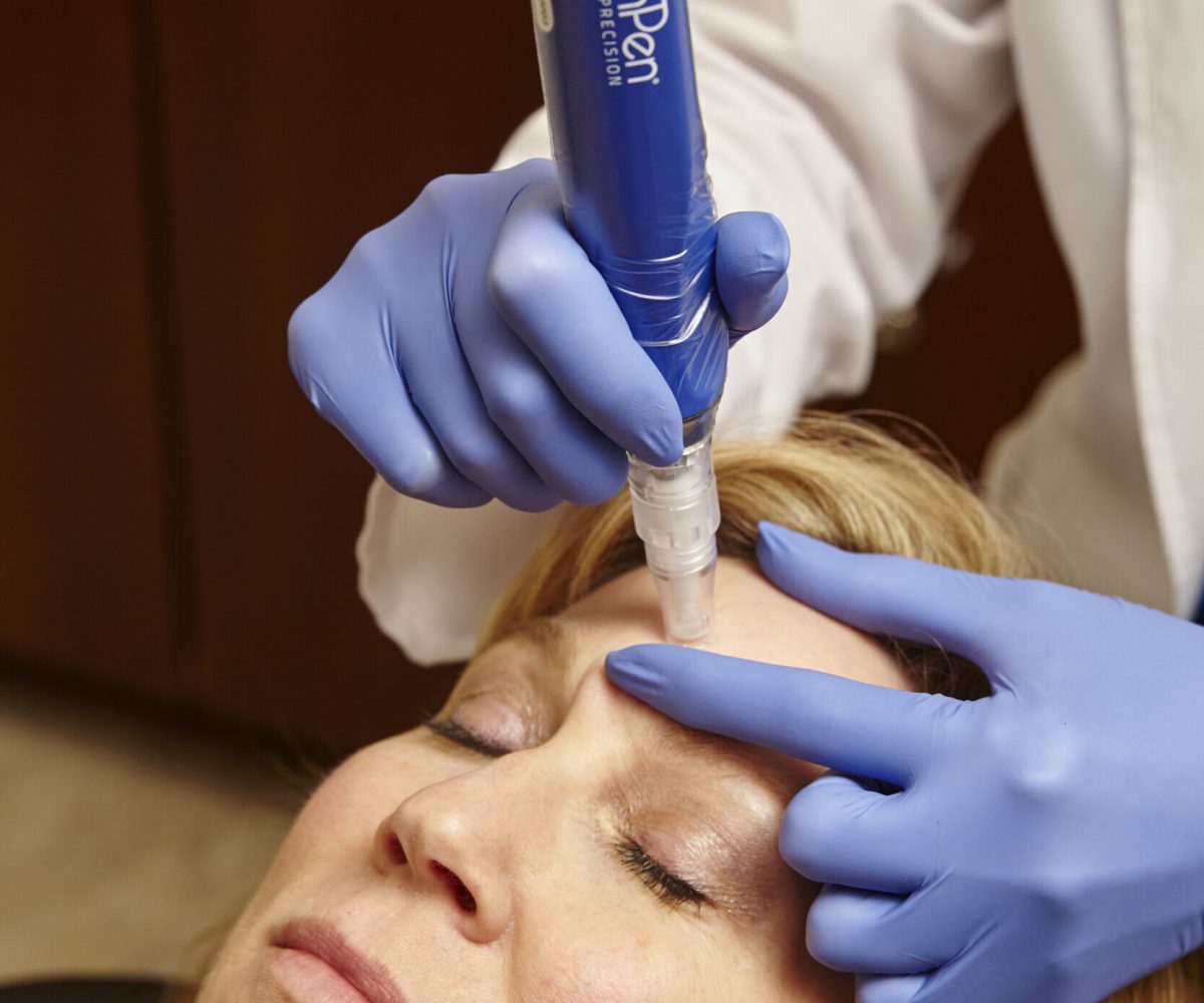 Microneedling Services for Radiant Complexion
