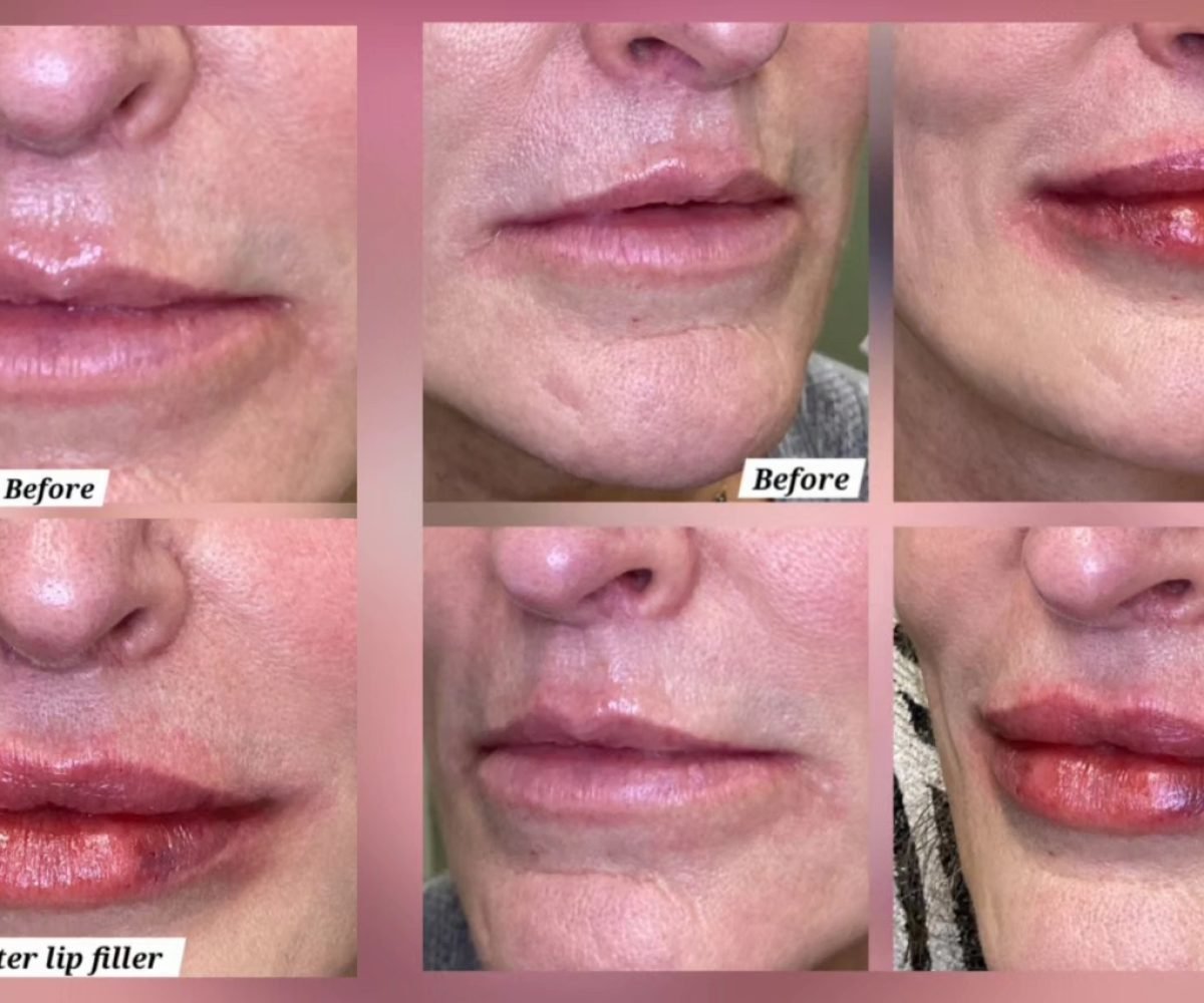increase Height lip