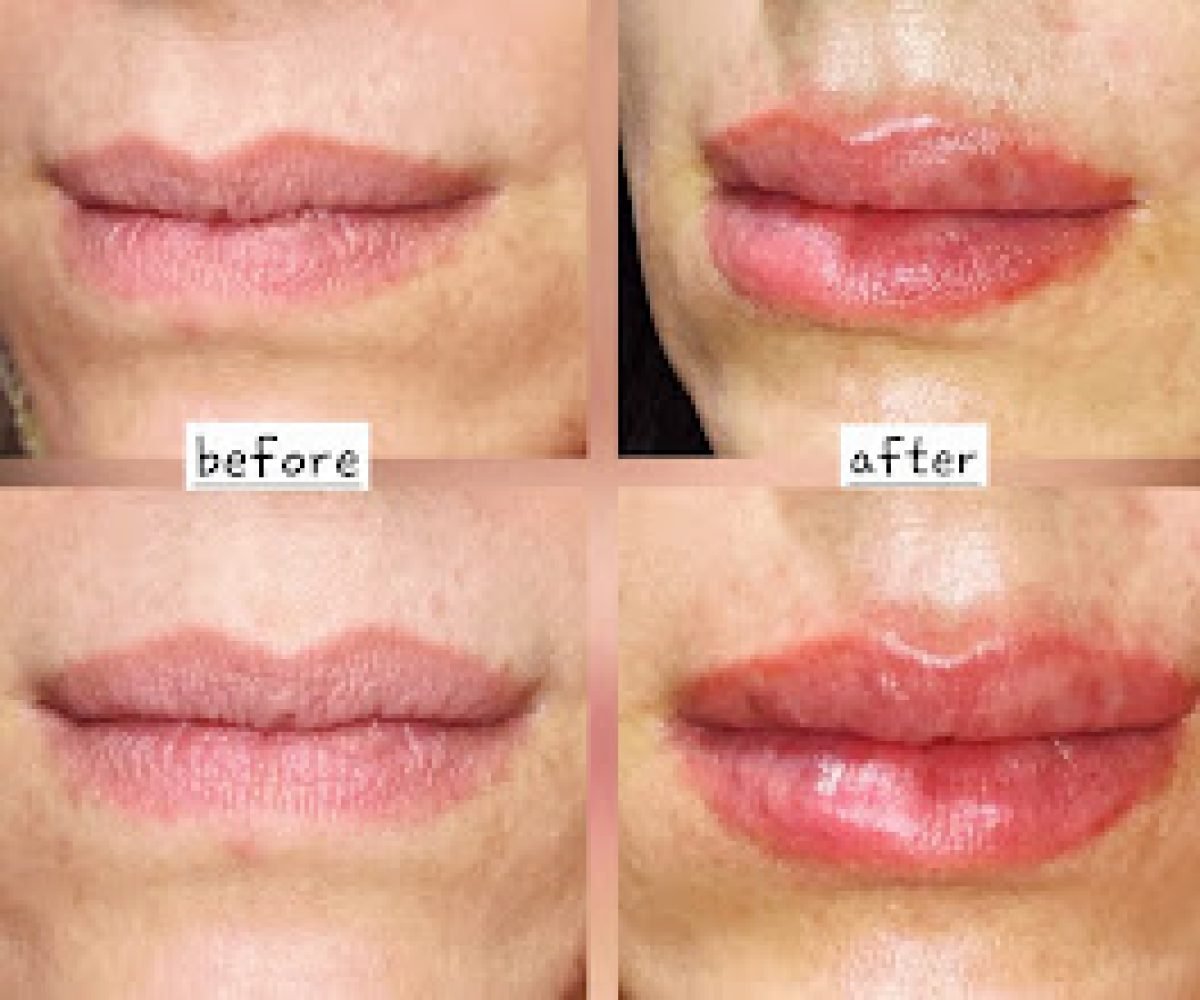 lip 2